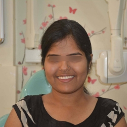 Root Canal Restoration in Moshi & Pradhikaran – Durable Crowns